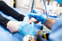 Laser Treatment for Fungal Toenails