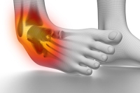 Definition and Causes of High Ankle Sprains
