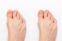 White Superficial Onychomycosis and Other Nail Infections