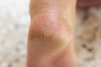 Causes and Treatment of Cracked Heels